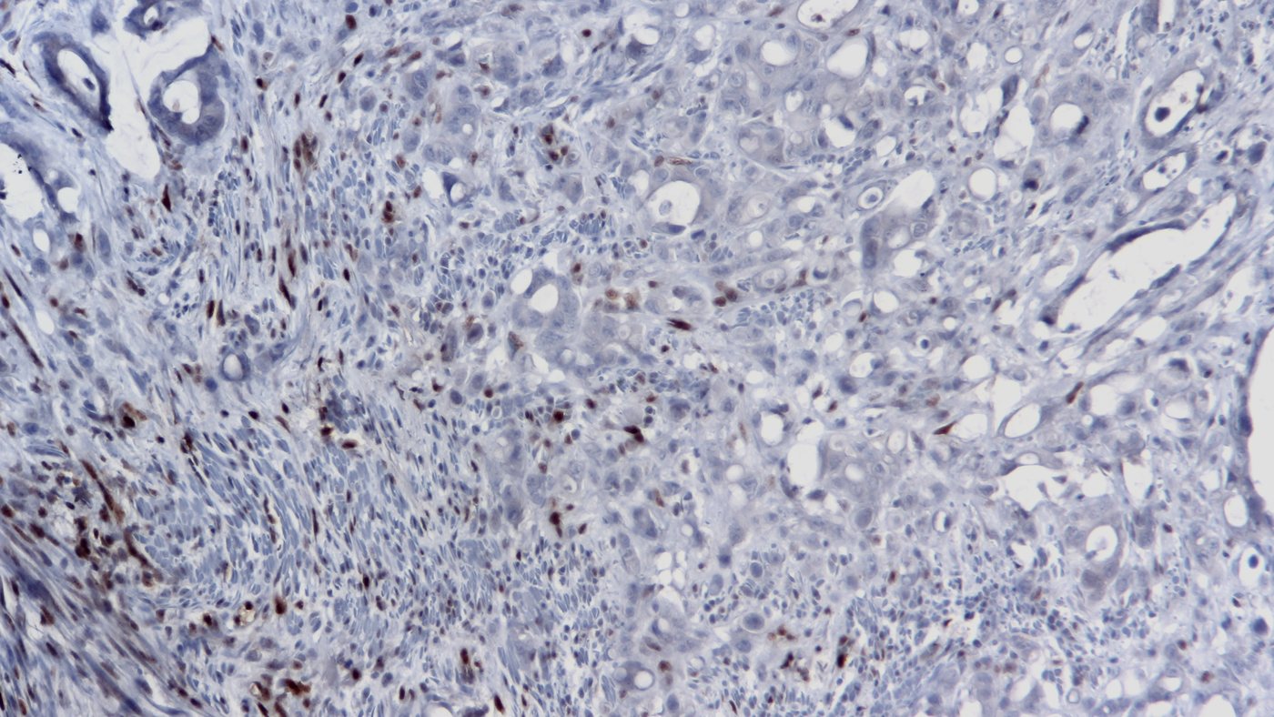 FDA Approves First Immunotherapy for Non-Surgical Rectal Cancer Treatment