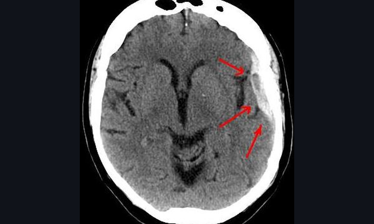A CT scan showing a crescent-shaped hemorrhage and midline shift.