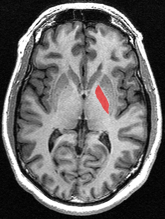 Horizontal brain MRI slice with the globus pallidus highlighted in red